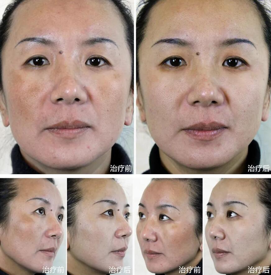 <strong>beaustry®问题肌肤终结者！祛斑专家 解析祛斑方法</strong>